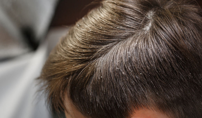 dandruff on head dandruff on head